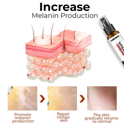 🌿 Herbal Vitiligo Relief Spray 🎉: Nature's Touch for Even Skin Tone ✨